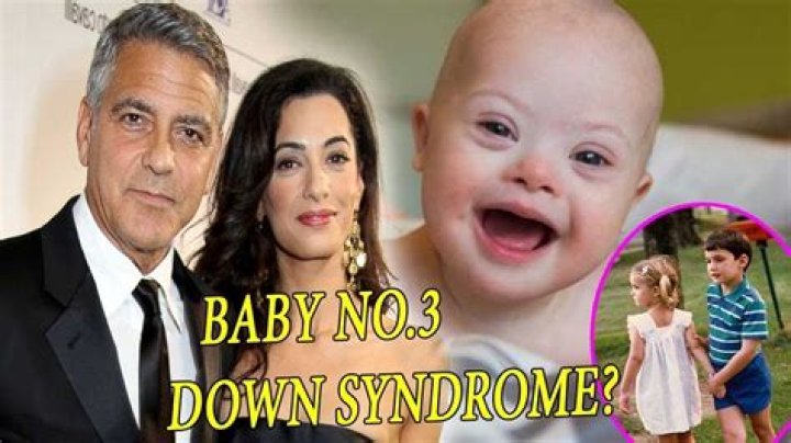 Are George Clooney's Twins Down Syndrome: An Exploration Of Facts And Speculations
